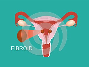 Illustration of the uterine fibroid. Intramural myoma