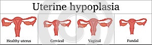 Illustration of Uterine hypoplasia