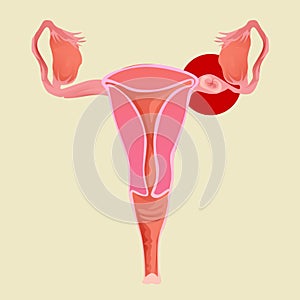 Illustration of uterus with ectopic pregnancy. gynecology photo