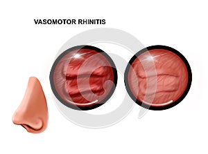 Illustration of vasomotor rhinitis of the nasal mucosa. healthy and inflamed