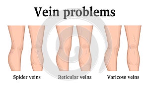 Illustration of vein problems