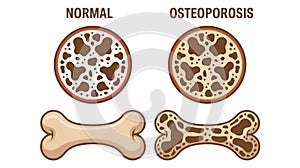 Normal vs. Osteoporosis Bone Comparison