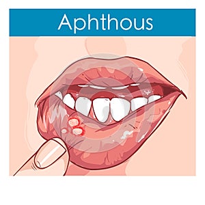 Illustration of a Woman with aphthae on lip photo