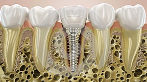 An illustrative cross-section of a dental implant within the jawbone. Generative AI photo