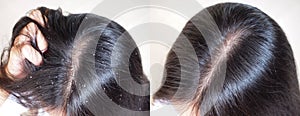 Image before and after anti dandruff treatment . photo