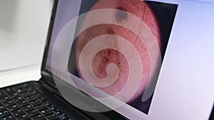 Image of a birthmark or warts close-up on a laptop monitor.