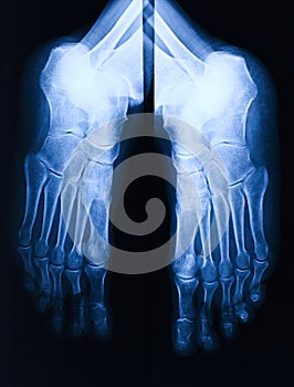 Foot xray