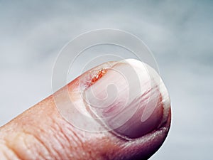 The image captures the texture and details of an injured finger