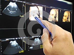 Mäkký rozmazaný obraz ruka lekár pero na obraz ultrazvuk  trojrozmerný  4z dieťa v matky maternica 