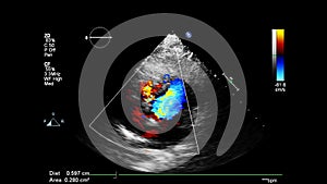 Image of the heart during transesophageal ultrasound.