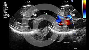 Image of the heart during transesophageal ultrasound.