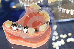 The image of the model of the human jaw and dentures.
