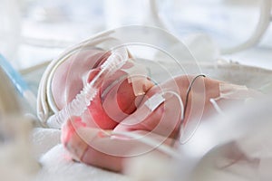 Image of the premature baby in incubator