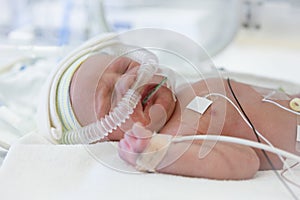 Image of the premature baby in incubator