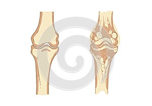 Osteoporosis Examples Illustration photo