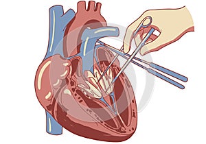 Heart Valve Surgery Illustration photo