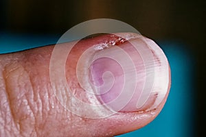 The image shows a finger with a visible, healing wound