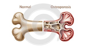 Normal Bone vs. Osteoporosis Bone Comparison