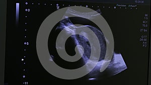 Image of woman uterus on monitor ultrasound examination equipment.