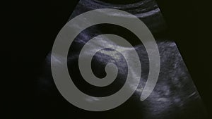 Image of woman uterus on monitor ultrasound examination equipment.