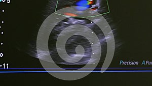 Image of woman uterus on monitor ultrasound examination equipment.