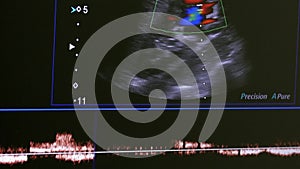 Image of woman uterus on monitor ultrasound examination equipment.