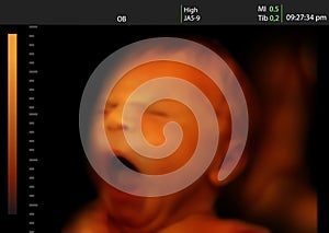 Image of a yawning newborn baby like 3D ultrasound