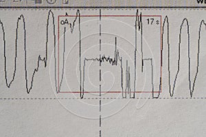 Images charts scientific cardiograms of cardiorespiratory sleep monitoring. Heart pulse or Heart wave, graph on paper. Medical photo