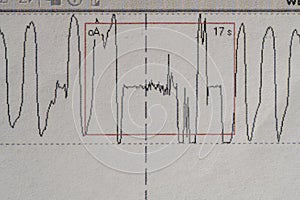 Images charts scientific cardiograms of cardiorespiratory sleep monitoring. Heart pulse or Heart wave, graph on paper. Medical