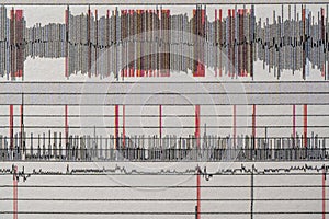 Images charts scientific cardiograms of cardiorespiratory sleep monitoring. Heart pulse or Heart wave, graph on paper. Medical photo