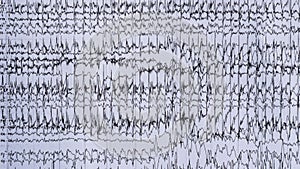 Imaging of ictal EEG recording in epilepsy patient