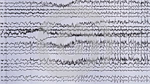 Imaging of ictal EEG recording in epilepsy patient