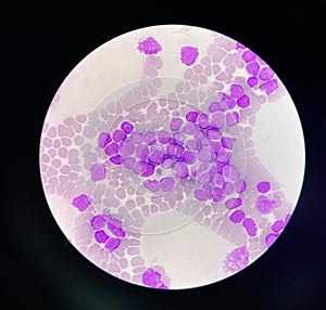 Immatture wbc Acute lyphoblastic leukemia