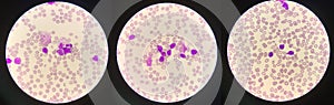 Immature  white blood cells in leukemia