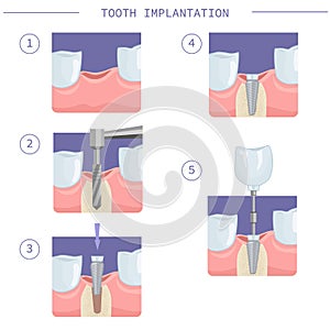 Immediate dental implantation. Modern dental implantation, step by step instructions. Vector illustration for dental textbooks