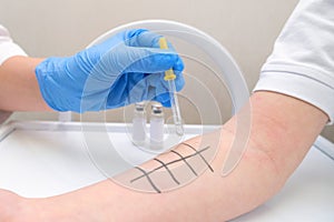 Immunologist Doing Skin Prick Allergy Test