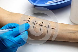 Immunologist doing skin prick allergy test on a patient arm