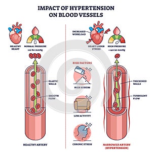 Impact of hypertension on blood vessels with high pressure outline diagram