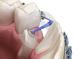 Impacted Cuspid and elastic for correction. Medically accurate dental 3D illustration