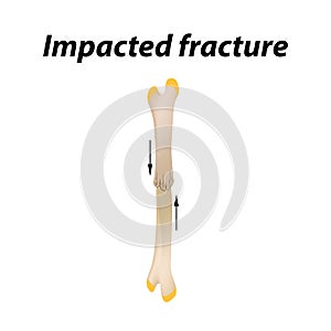 Impacted fracture Bone. Infographics. Vector illustration on a lined background.