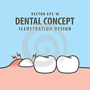 Impacted tooth inside under inflammation gum illustration vector