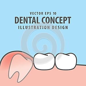 Impacted tooth inside under inflammation gum illustration vector