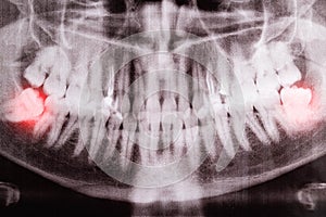 Impacted wisdom teeth on an X-ray picture with an inflamed cyst neoplasm. Removal of wisdom teeth in dentistry