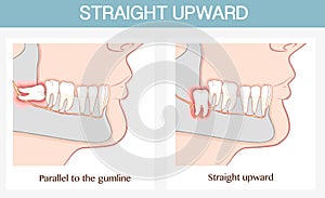 Impacted wisdom tooth  vector illustratin