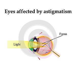 Impaired vision with astigmatism. As astigmatism