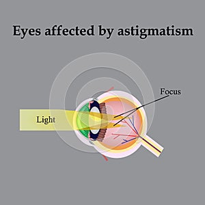 Impaired vision with astigmatism. As astigmatism