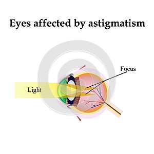 Impaired vision with astigmatism. As astigmatism photo