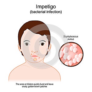 Impetigo. Face baby with a skin infection