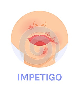 Impetigo. Skin Infection. Red Spots near the Mouth and Nose. Part of a Woman Face. Female Lips Nose and Neck. Color Cartoon style