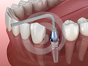 Implant abutment fixation procedure. Medically accurate 3D illustration of human teeth and dentures